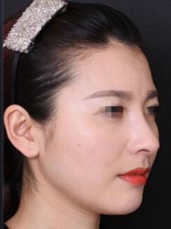 隆鼻失败修复