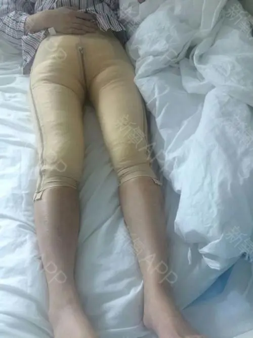 吸脂手术术后的效果好不好