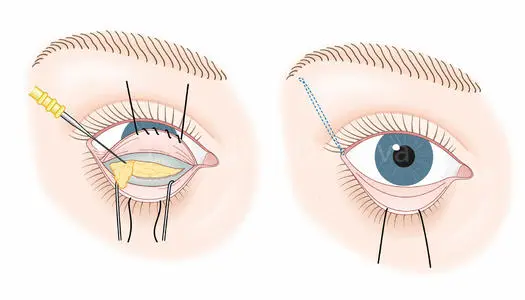眼袋切除手术后需要多长时间恢复？