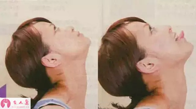 怎样变成瓜子脸不整容