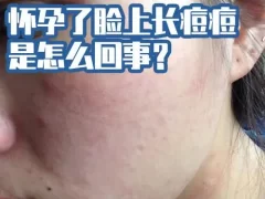 怀孕期间脸上长痘痘要怎么解决好?-女人美