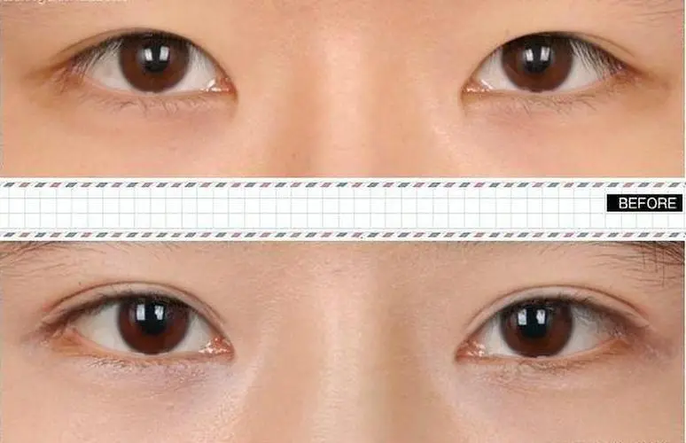 韩式双眼皮