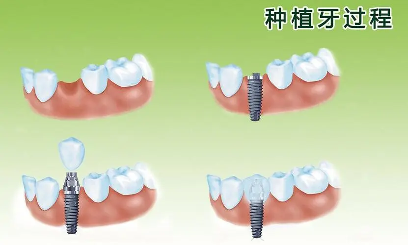 种植牙多少钱