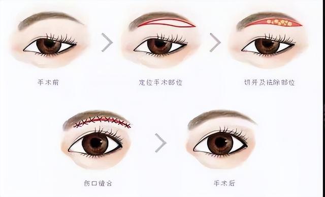 做眼部切眉得多少钱