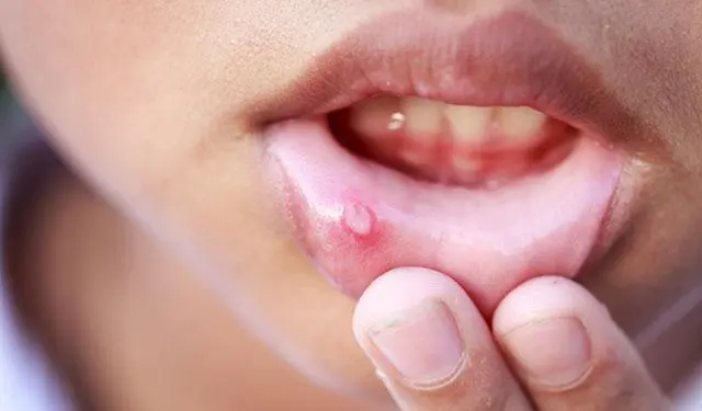 口腔溃疡是缺乏哪种维生素