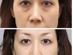 眼部整形手术:从心动到行动,你需要知道的一切-女人美