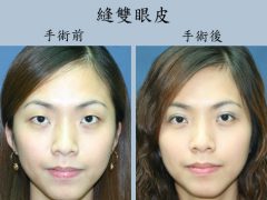 眼部整形哪里好?-女人美