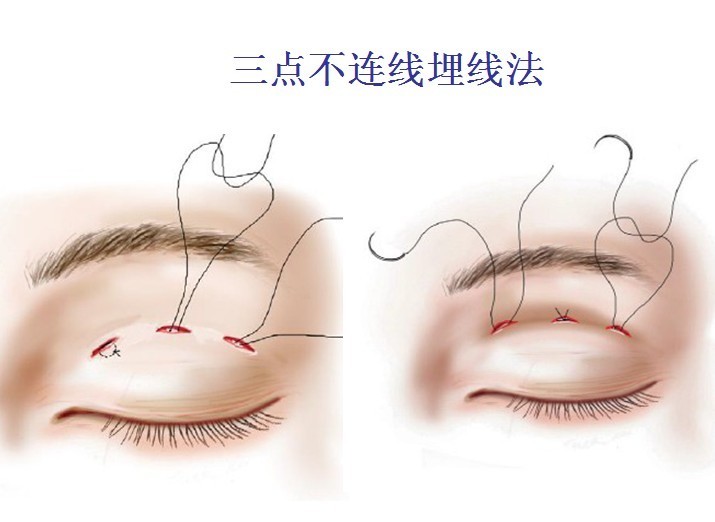 整形手术一般要多少钱？别让